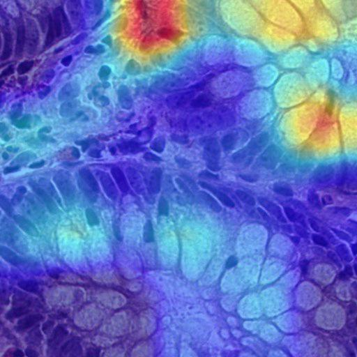 Grad-CAM: CCHMC model predicted as Crohn's disease — highlighting lymphocytes in lamina propria