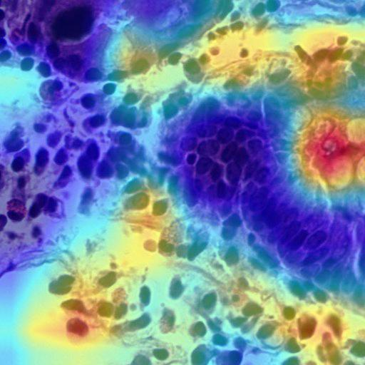 Grad-CAM: INOVA model predicted as Crohn's disease — highlighting goblet cells and white space